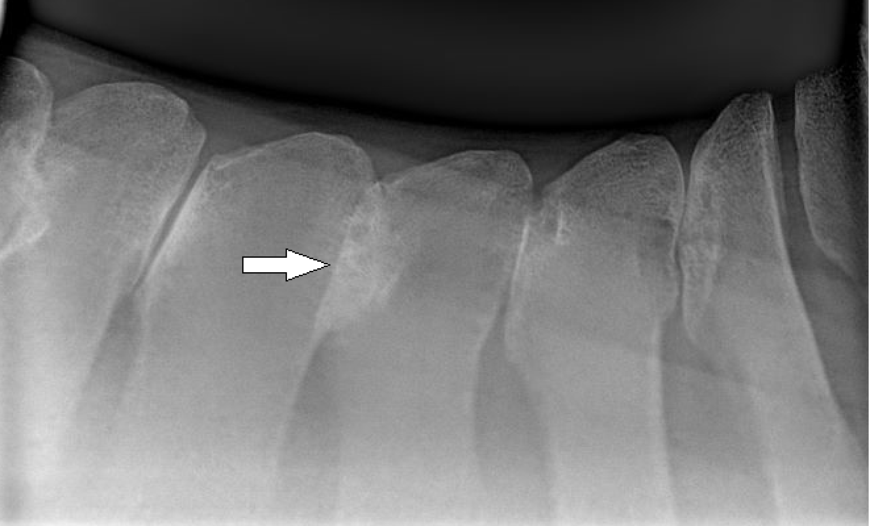 Kissing spines